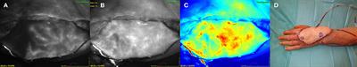 Enhancing Safety in Reconstructive Microsurgery Using Intraoperative Indocyanine Green Angiography